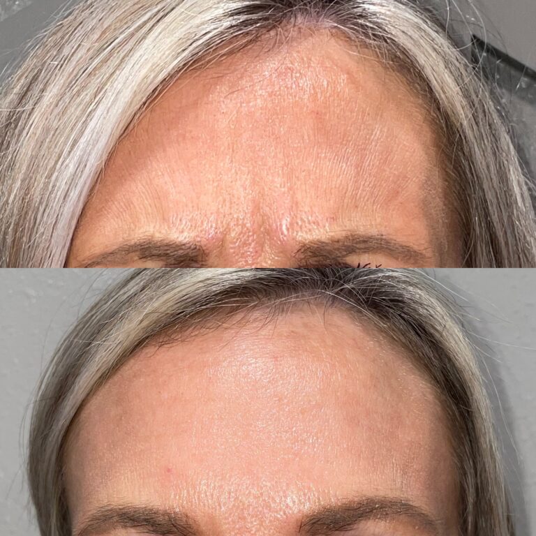 botox before and after picture for slider