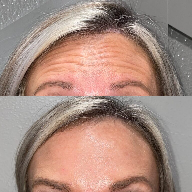 botox before and after picture for slider