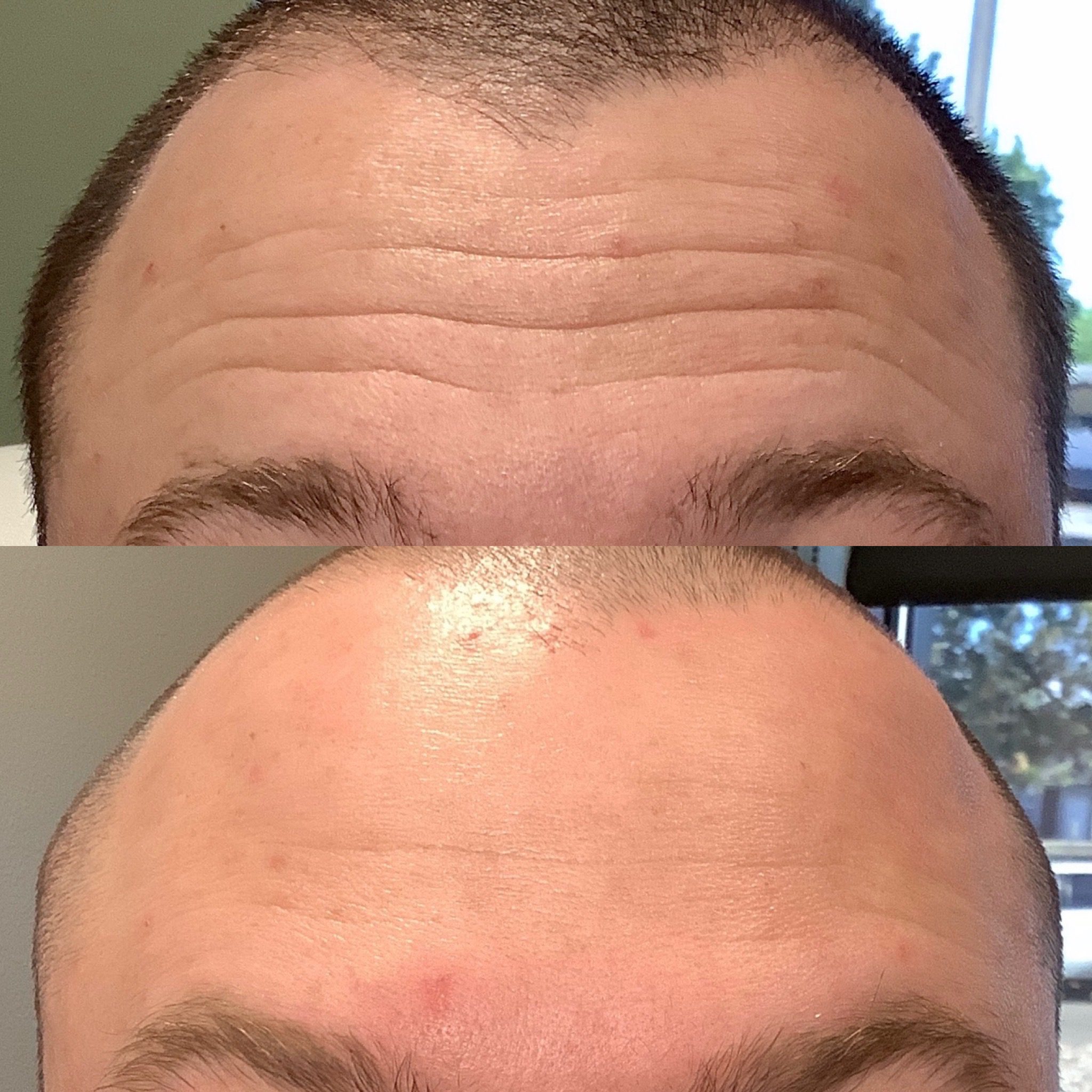 botox before and after picture for slider